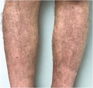 Complete clinical remission after 6-months of therapy, with residual post-inflammatory pigmentation. Patient achieved and maintained PASI 0 without the need for topical or systemic rescue therapy.
