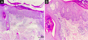 (A‒B) Histopathological findings from two punch biopsies showed similar changes: parakeratotic crust with nuclear debris and surface hemorrhage, partial acanthosis with loss of the granular layer, mild spongiosis, interface vacuolar degeneration, and isolated dyskeratosis, particularly around the follicles. In the dermis, perivascular lymphocytic inflammation was also noted.