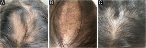 (A) Hyperkeratotic alopecic plaques with scaling and erythema located in the frontoparietal area of the scalp at presentation. (B) Further hair regrowth and near-complete resolution of the alopecic plaque after 8-weeks of bimekizumab (320 mg) therapy. (C) Complete resolution of scalp scaling and restoration of normal skin texture at the 6-month follow-up, with near-complete hair regrowth except for mild residual thinning along the midline.