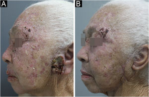 (A) Preauricular ulcerated tumor lesion and multiple hypertrophic actinic keratoses – during HU use; (B) Linear scar after surgical excision and significant regression of actinic keratoses on the face – six months after HU discontinuation.
