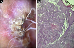(A) Dermoscopy of the left preauricular lesion: white circles, radial linear vessels and punctate lesions. (B) Histopathology: infiltrative blocks of atypical keratinocytes in the dermis, corneal pearls, keratinization and dyskeratosis foci (Hematoxylin & eosin – ×100).