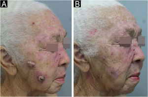 (A) Multiple erythematous, keratotic papules and plaques, and two ulcerated nodules – six months after HU discontinuation. (B) Spontaneous resolution of nodular lesions and improvement of actinic keratoses are observed – nine months after HU discontinuation.