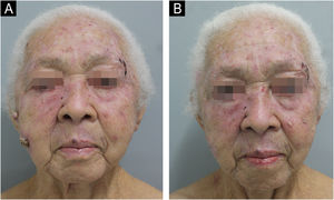 (A) Multiple erythematous, keratotic papules and plaques, and two ulcerated nodules – six months after HU discontinuation. (B) Spontaneous resolution of nodular lesions and improvement of actinic keratoses are observed – nine months after HU discontinuation.