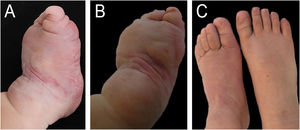 Patient 1 (A) Infiltrative angiomatous tumor affecting mainly the anterior and middle part of the foot, at four months of age. (B) At ten months of age, after five months of systemic corticosteroids – lesion with hardened consistency, without significant decrease in volume. (C) At six years of age – after using ASA, the feet acquired a normal diameter, allowing the child to wear shoes of the same size.