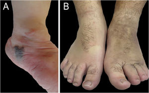 Patient 1(A) Appearance at three years of age after an attempt to discontinue aspirin – appearance of ecchymosis and increased volume. (B) At 16 years of age, maintaining aspirin use at a dose of 100 mg/day.