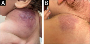 Patient 2 (A) Angiomatous tumor in the posterior region of the left trunk (trapezius region), at four months of age, before treatment with ASA and while using oral prednisolone. (B) Appearance at 18 months of age, without oral corticosteroids and maintaining ASA use.