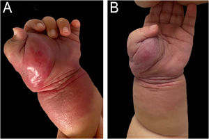 Patient 3 (A) Angiomatous tumor in the left upper limb, at three months of age, before the start of treatment with ASA and while using oral prednisolone. (B) At five months, with a significant decrease in volume, two months after starting ASA.