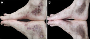 Livedoid vasculopathy. (A) Typical ulcerated and purpuric lesions on the ankles and feet, with progressive resolution of the LV after one month of abrocitinib use. (B) Follow-up after six months, showing complete remission with baricitinib use.