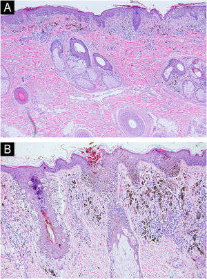 (A) Hematoxylin & eosin stain, original magnification ×10. Continuous lentiginous growth of atypical melanocytes with formation of large nests. Melanocytic infiltration of the deep dermis and adnexal structures is also observed, a characteristic feature of congenital nevi. (B) Hematoxylin & eosin stain, original magnification ×40. Large, atypical melanocytes showing pagetoid spread and infiltration of the hair follicle.