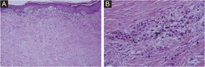 (A) Nevus cell nests in the superficial dermis (Hematoxylin & eosin, ×100). (B) Collagen bundles and fibroblasts surrounding nevus cell nests (Hematoxylin & eosin, ×400).