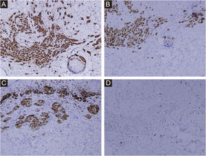 Immunohistochemical staining (A) S100 Staining, ×200. (B) Melan-A Staining, ×200. (C) HMB45 Staining, ×200. (D) Ki-67 Staining, ×200.