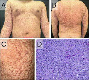 Clinical presentation of the lesions and histopathological examination of one of the lesions. (A‒B) Generalized flesh-colored papules with a 
