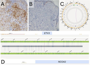 Immunohistochemistry of one of the lesions and optical genomic mapping of the tumor sample. (A) Diffuse positivity for CD1a (CD1a, 10×). (B) Negativity for CD207/langerin (CD207/langerin, 10×). (C and D) Graphical representation of the Optical Genomic Mapping with the interchromosomal translocation t(1;8) (q23.1;q13.3).
