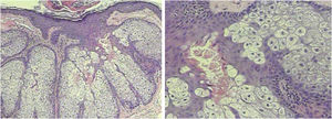 Histopathology showing sebaceous hyperplasia (Hematoxylin & eosin, ×100/400).