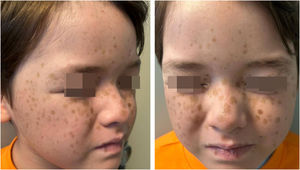(A and B) 7-year-old boy with multiple well-demarcated hyperpigmented macules symmetrically distributed on the cheeks, nasal dorsum, and frontal region.