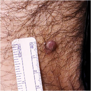 Case 1: Atypical fibroxanthoma on the inguinal region.