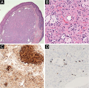 Case 1: (A) Hematoxylin and eosin staining showing a well-demarcated, non-encapsulated dermal tumor (40× magnification). (B) Hematoxylin & eosin staining showing pleomorphic spindle and epithelioid cells, as well as foamy histiocyte-like cells with atypical mitoses (400× magnification). (C) CD68 Immunohistochemistry (IHC) showing strong positivity in the tumor cells (100× magnification). (D) Ki-67 IHC showing a labeling index of around 10% in tumor cells (100× magnification).