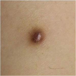 Case 2: Atypical fibroxanthoma of the right thigh.