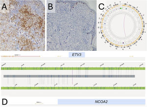 Immunohistochemistry of one of the lesions and optical genomic mapping of the tumor sample. (A) Diffuse positivity for CD1a (CD1a, 10×). (B) Negativity for CD207/langerin (CD207/langerin, 10×). (C and D) Graphical representation of the Optical Genomic Mapping with the interchromosomal translocation t(1;8) (q23.1;q13.3).