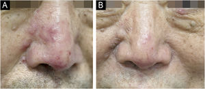 Clinical images of Patient 1 with papulopustular rosacea. (A) Nasal erythematous papules at baseline. (B) After 4-weeks of once-daily 1% tapinarof cream.