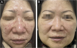 Clinical images of Patient 2 with papulopustular rosacea. (A) Centrofacial persistent erythema with papules and pustules at baseline. (B) After 8-weeks of treatment.