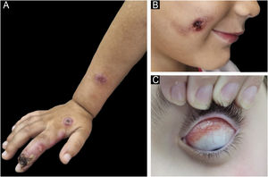 Clinical presentation of sporotrichosis in children. (A) Cutaneous-lymphatic form. (B) Localized cutaneous form. (C) Mucosal (ocular) form.