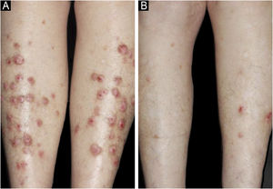 (A) Case 20 ‒ the lesions were limited to the legs in this patient. (B) Same patient after 6-months taking doxepin 35 mg/day.