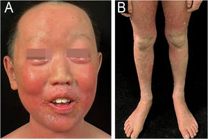 Clinical presentation. (A) Diffuse erythema and fine-to-lamellar scaling over the head and face, accompanied by sparse scalp hair. (B) Diffuse erythema on the limbs.