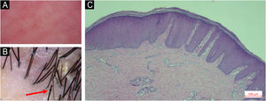 Dermoscopic and histopathological findings. (A) Dermoscopy showing dotted vascular dilatation and scattered scales. (B) Trichoscopy with trichorrhexis invaginata (‘bamboo hair’) on the scalp. (C) Histopathological examination revealing hyperkeratosis, acanthosis, and superficial perivascular lymphocytic infiltration (Hematoxylin & eosin, 200×).