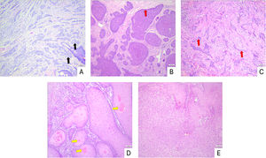 Histopathology of non-melanoma skin lesions (Hematoxylin & eosin stain) (A) Intradermal nevus, nests of round to oval nevus cells (black arrow) within the dermis. (B) Nodular BCC, basaloid nests with peripheral palisading (red arrow). (C) Infiltrative BCC, strands and cords of basaloid cells (red arrow) infiltrating the dermis. (D) Well-differentiated SCC, squamous nests with prominent keratinization and keratin pearls (yellow arrow). (E) Moderately differentiated SCC, squamous nests with intermediate keratinization. Scale bars: 100 µm.