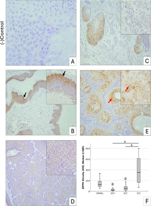 Immunohistochemical staining of EPPK1 in skin samples. (A) Negative control. (B) Normal skin, intense cytoplasmic EPPK1 expression in stratum granulosum (black arrow) and mild in stratum spinosum. (C) Intradermal nevus, very low cytoplasmic EPPK1 expression. (D) Basal cell carcinoma, moderate cytoplasmic EPPK1 expression. (E) Squamous cell carcinoma, strong cytoplasmic EPPK1 expression, especially in cells surrounding keratin pearls (red arrow). Scale bars: A, insets 30 µm, B–E 100 µm. (F) Boxplot showing EPPK1 optical density as median ± IQR; whiskers indicate minimum–maximum. Kruskal-Wallis test, * p < 0.05, a, Significantly different from normal skin and SCC. BCC, Basal Cell Carcinoma; SCC, Squamous Cell Carcinoma; IQR, Interquartile Range.