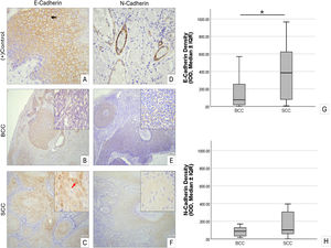 Immunohistochemical staining of E-cadherin and N-cadherin in skin samples. (A) Normal skin, E-cadherin predominantly at intercellular junctions with lower cytoplasmic expression. (B) BCC, E-cadherin cytoplasmic expression. (C) SCC, E-cadherin cytoplasmic expression, with increased intensity in some cells. (D) Normal skin, intense N-cadherin in vascular walls. (E) BCC, N-cadherin cytoplasmic expression. (F) SCC, low N-cadherin expression. Scale bars: A, D, insets 30 µm; B, C, E, F 100 µm. (G) Boxplot of E-cadherin optical density (median ± IQR), SCC significantly higher than BCC. (H) Boxplot of N-cadherin optical density (median ± IQR). Whiskers indicate minimum – maximum. Kruskal-Wallis test, * p < 0.05. BCC, Basal Cell Carcinoma; SCC, Squamous Cell Carcinoma; IQR, Interquartile Range.