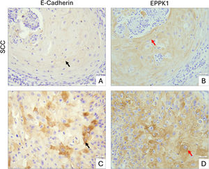 Immunohistochemical staining of E-cadherin and EPPK1 in SCC. (A‒B) Well-differentiated SCC, E-cadherin predominantly at intercellular junctions (black arrow) and corresponding region showing intense cytoplasmic EPPK1 expression (red arrow). (C‒D) Another area of the same SCC tumor, showing regionally increased cytoplasmic E-cadherin in some tumor cells (black arrow) and widespread cytoplasmic upregulation of EPPK1 across the same region (red arrow). Scale bars: 30 µm.