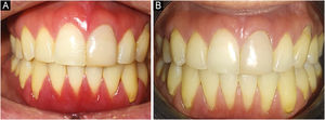 Clinical evolution: baseline and three-month post-treatment comparison. (A) Baseline clinical presentation (as shown in Fig. 1A). (B) Three-month follow-up showing resolution of erythema and edema, re-establishment of knife-edge contour, and residual recession due to previous gingival attachment loss.