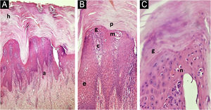 Histopathological examination of the plantar region. Panel A: Acanthosis, hyperkeratosis (h), elongation (a) of the epithelial ridges (Hematoxylin & eosin, ×100). Panel B: Proliferation of papillary capillaries (c), inflammatory infiltrate (i), parakeratosis (p), hypogranulosis (g), intraepidermal microabscess (m), discrete spongiosis (e) (Hematoxylin & eosin, ×200). Panel C: Hypogranulosis, with the presence of intraepidermal and subcorneal neutrophils (n) (Hematoxylin & eosin, ×400).