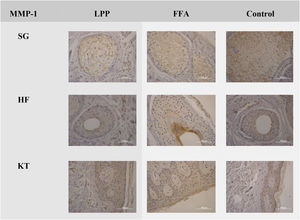 Negative expression of MMP-1 in LPP, FFA, and control groups in the sebaceous glands (SG), hair follicles (HF) and keratinocytes (KT) ×100. Source: research original data.