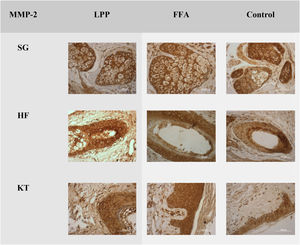 Same expression of MMP-2 in LPP, FFA, and control groups in the sebaceous glands (SG), hair follicles (HF) and keratinocytes (KT) ×100. Source: research original data.