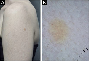 (A) Patient with oculocutaneous albinism presenting with a 0.4 cm non-pigmented nevus on the left upper limb. (B) Dermoscopy with polarized light reveals yellowish structures in the central region.