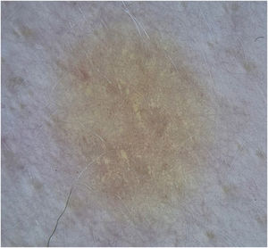 Higher dermoscopic magnification with polarized light showing millimeter-sized punctate vessels, distributed globally and symmetrically throughout the lesion.