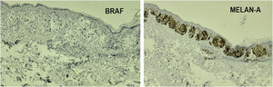 Immunohistochemistry examination of the patient: left showing negative BRAF staining in cells of interest (BRAF ×10); right showing positive Melan A staining in cells of interest (Melan A ×10).