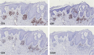 Immunohistochemistry. Positivity in the superficial dermal infiltrate for CD3, CD4 and CD7, and negative for CD20 (×100).