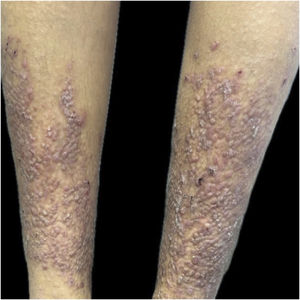 Erythematous and hyperkeratotic papules on the legs, before treatment.