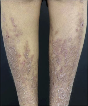 After 30 days of baricitinib 4 mg/day: Papules begin to resolve.