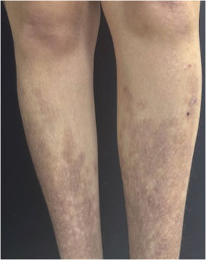 After 90 days of baricitinib 4 mg/day: almost complete resolution of the lesions, with residual hyperpigmentation.