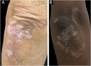 Clinical presentation of psoriasis plaques demonstrating the challenges of erythema recognition in SOC. (A) A typical erythematous plaque of psoriasis clearly seen on lighter skin. (B) A psoriasis plaque presenting with violaceous, hyperchromic, and grayish tones on darker skin, illustrating the variability in visual appearance. Such differences underscore the importance of recognizing non-traditional signs of inflammation to accurately diagnose and assess psoriasis severity in SOC patients.