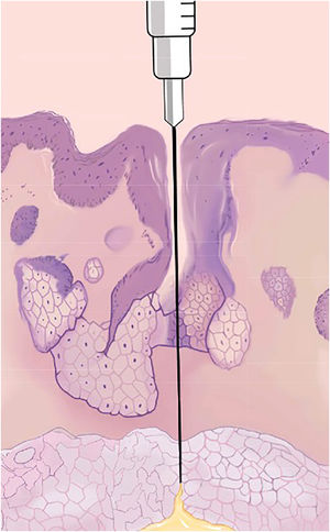 Injection plane and pore-guided injection.