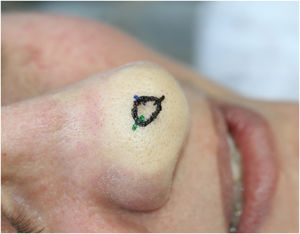 Edema endpoint.