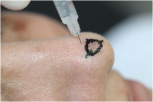 Needle Insertion Angle. It is recommended to first inject the proximal part of the nasal tip because it will “block” the distal portion.