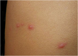 Acute varicella lesion. Courtesy: Lauro Lourival Lopes Filho, MD, Ph.D.