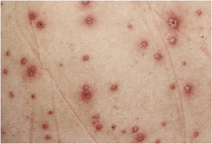 Polymorphic rash of varicella. Courtesy: Silvio Alencar Marques, MD, PhD.